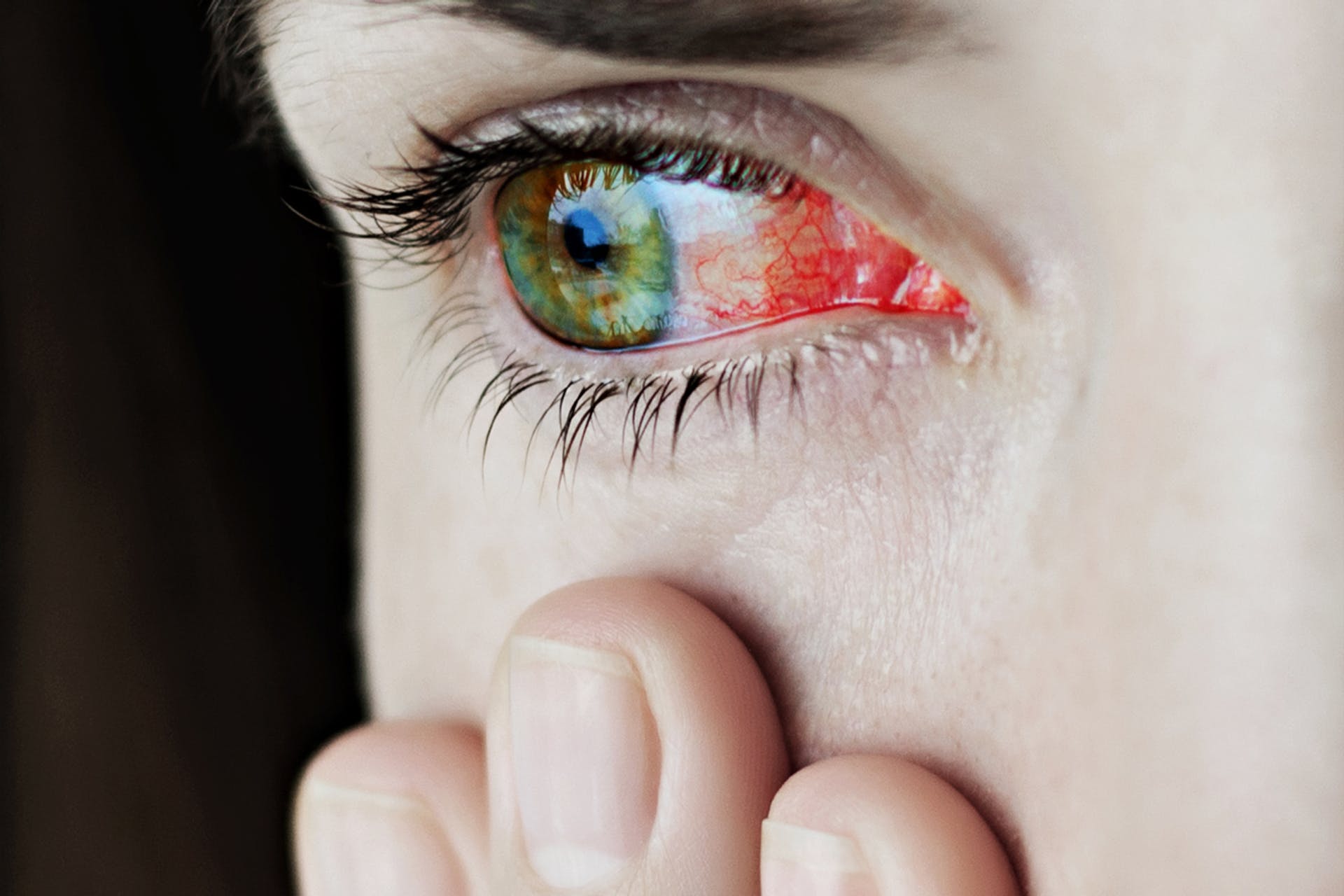 Kötőhártya gyulladás